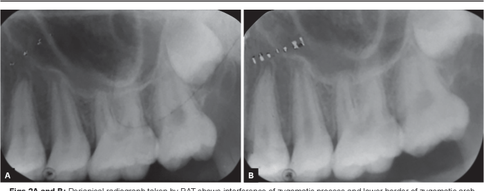 Zygomatic process of maxilla radiograph