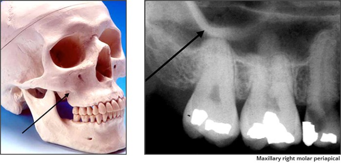 Zygoma zygomatic bone fracture anatomy figure side