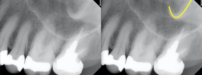 Zygomatic process of maxilla radiograph