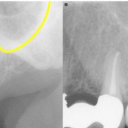 Zygomatic temporal bone process lateral