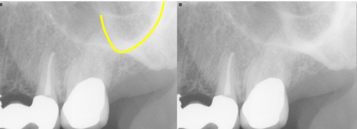 Zygomatic temporal bone process lateral